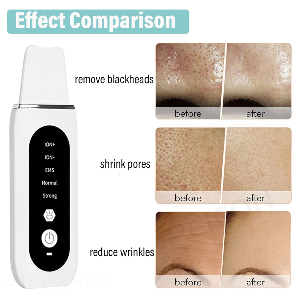 Ultrasonic Skin Scrubber Ultrasonic Deep Face Cleaning Peeling Blackhead Remover Facial Shovel Cleanser Lifting Skin Care